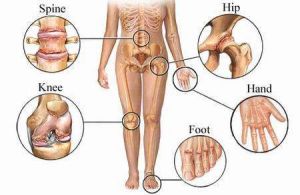 arthritis-diagram