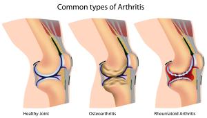 Rheumatoid-Arthritis